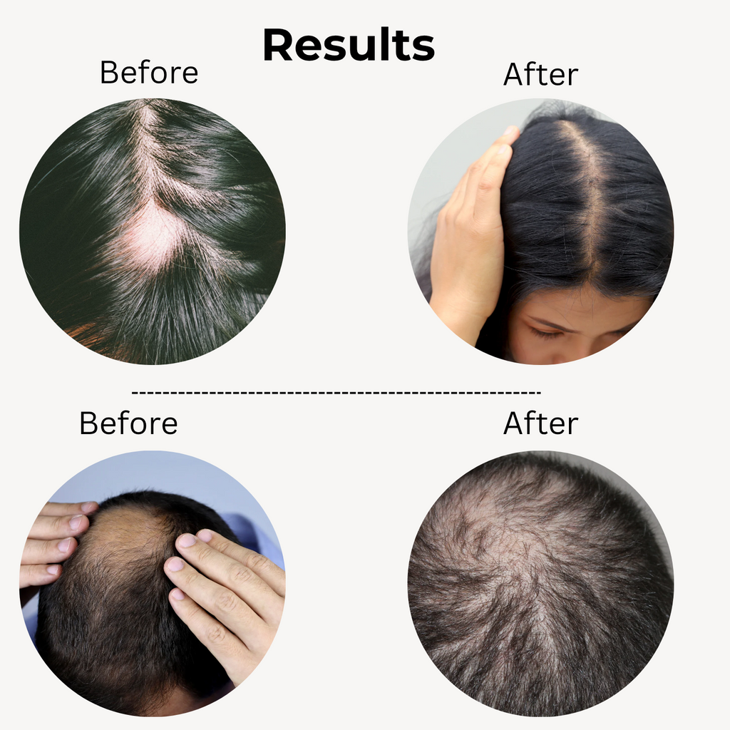 Before and after results using Relaxiz Hair Growth Oil for thinning hair and bald spots